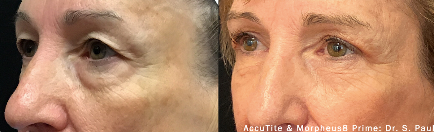 Image of AccuTite before and after