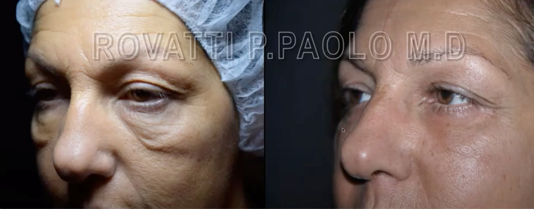Image of AccuTite before and after