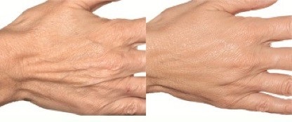 Hand before after filler volumization