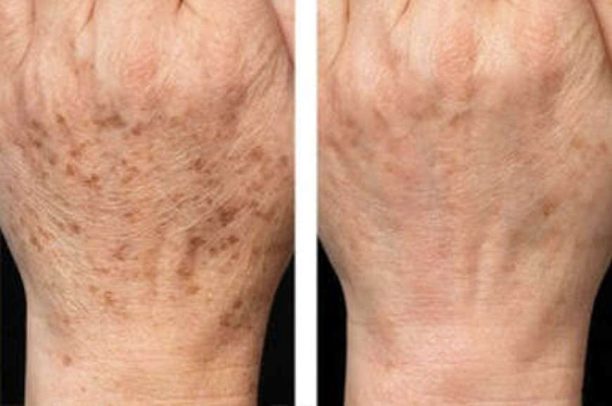 Hand before after ipl photorejuvenation