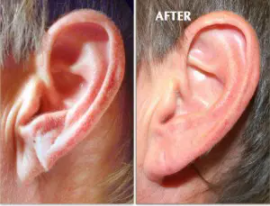 Earlobe rejuvenation before after